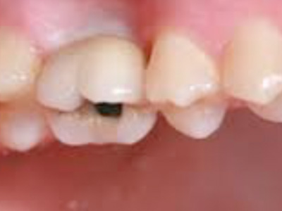 Implantes dentales